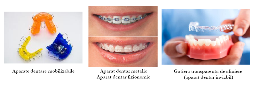 Tipuri de aparate dentare_Ardentis