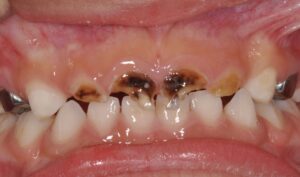 Carii dentare frontale_Stomatologie copii Dej