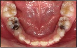 Carii dentare_ Stomatologie pediatrica